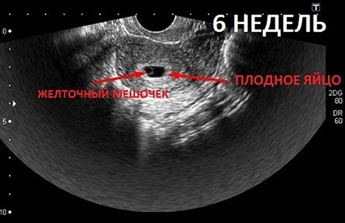 Плодное Яйцо 4 Недели Фото