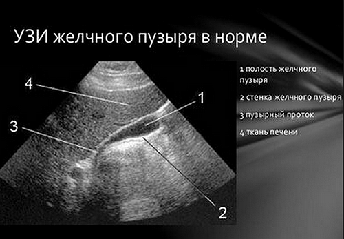 Диета перед узи желчного пузыря что можно кушать