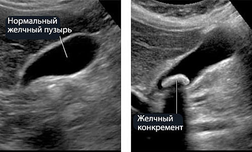 Диета перед узи желчного пузыря что можно кушать