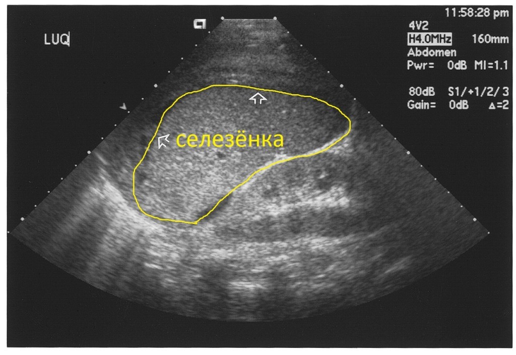 УЗИ селезенки с функциональной пробой