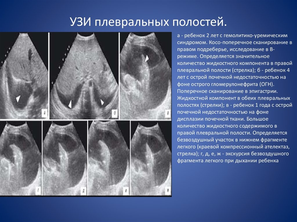 Определение объема жидкости по УЗИ плевральной полости