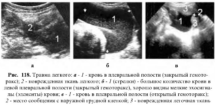 Определение объема жидкости по УЗИ плевральной полости