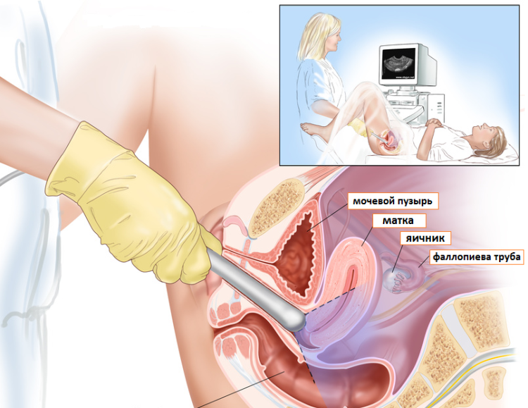 Трансвагинальное обследование