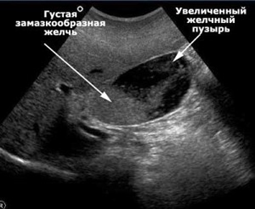 Сгустки в желчном пузыре. Замазкообразная желчь в желчном пузыре на УЗИ. Сладж в желчном пузыре УЗИ. Густая желчь в желчном пузыре УЗИ. Расширенный проток желчного пузыря.