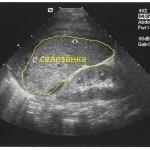 УЗИ селезенки с функциональной пробой