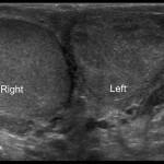 УЗИ органов мошонки — особенности исследования